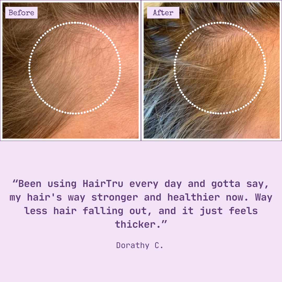 6 Month Supply - HairTru™ 3 in 1 Pro-Grade Vitamins for Hair Growth