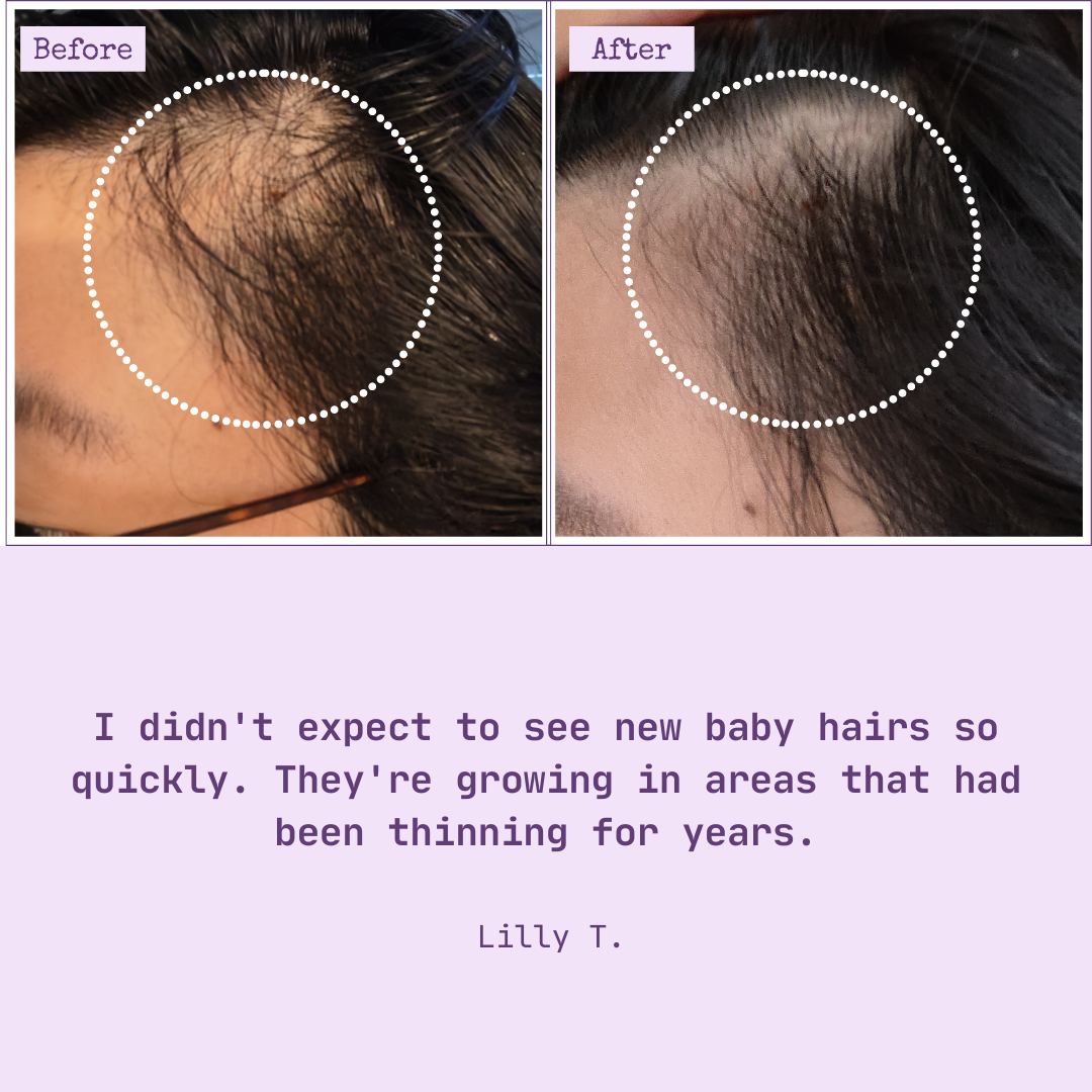 HairTru™ Pro-Grade Vitamins For Hair Growth