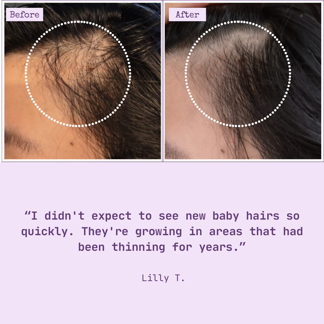 2 Month Supply - HairTru™ 3 in 1 Pro-Grade Vitamins for Hair Growth