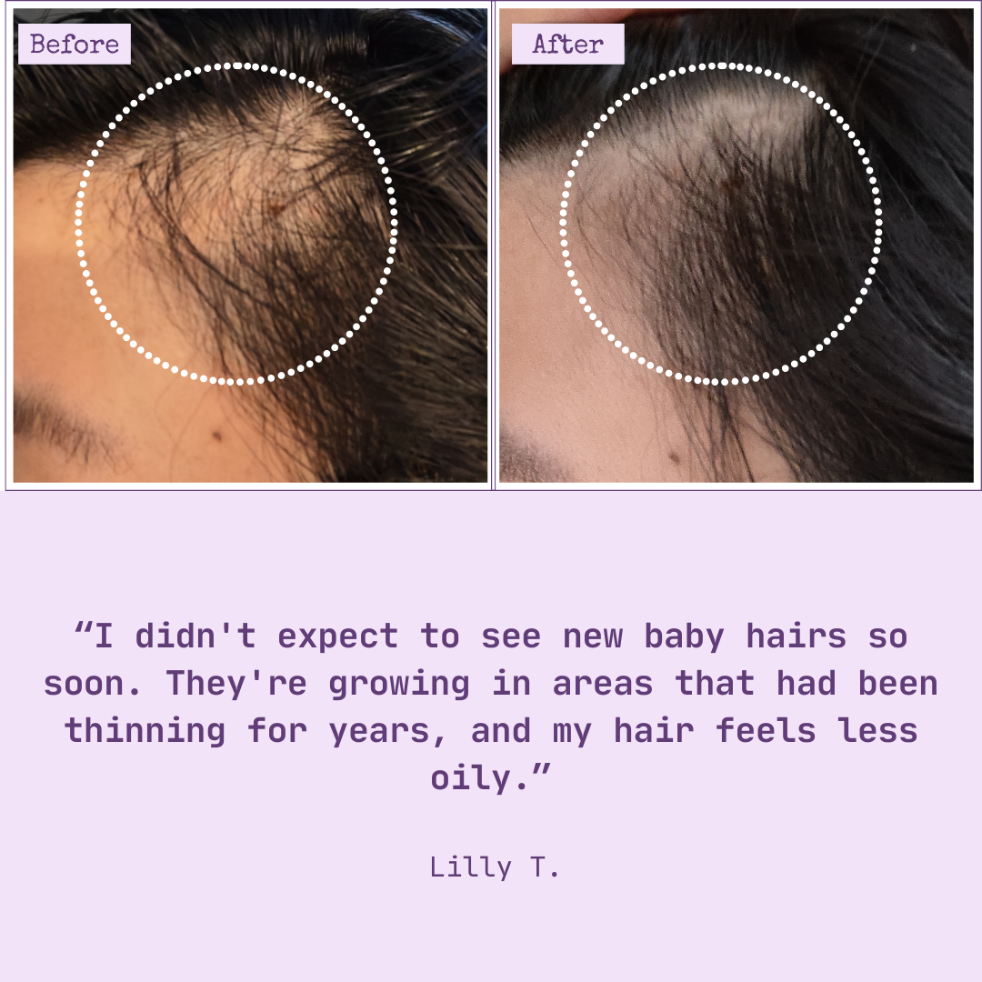 6 Month Supply - HairTru™ 3 in 1 Pro-Grade Vitamins for Hair Growth
